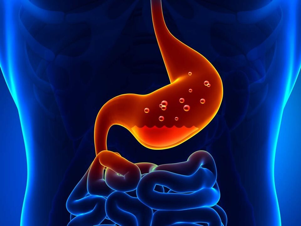 Gastrit, diyet gerektiren midenin iltihabi bir hastalığıdır. 